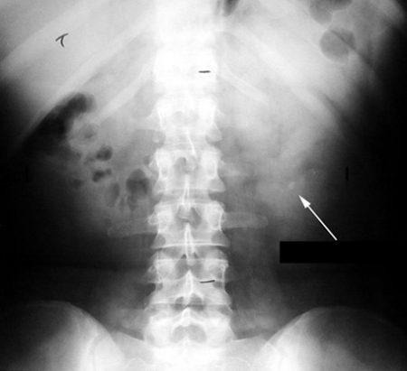 Interpreting An Abdominal X-Ray (KUB) - Stepwards