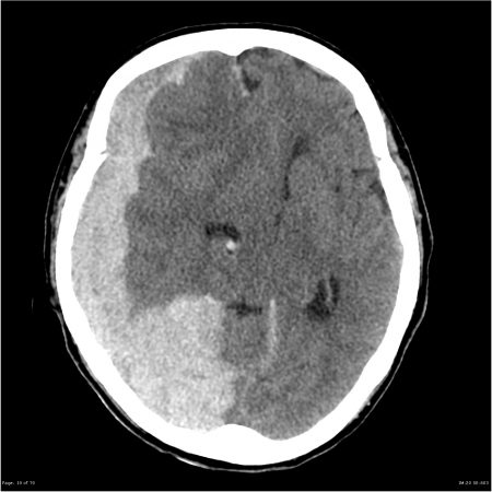 Subdural Hematoma/Hemorrhage - Stepwards