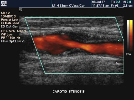 Carotid Artery Stenosis - Stepwards