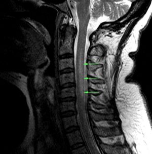 Subacute Combined Degeneration - Stepwards