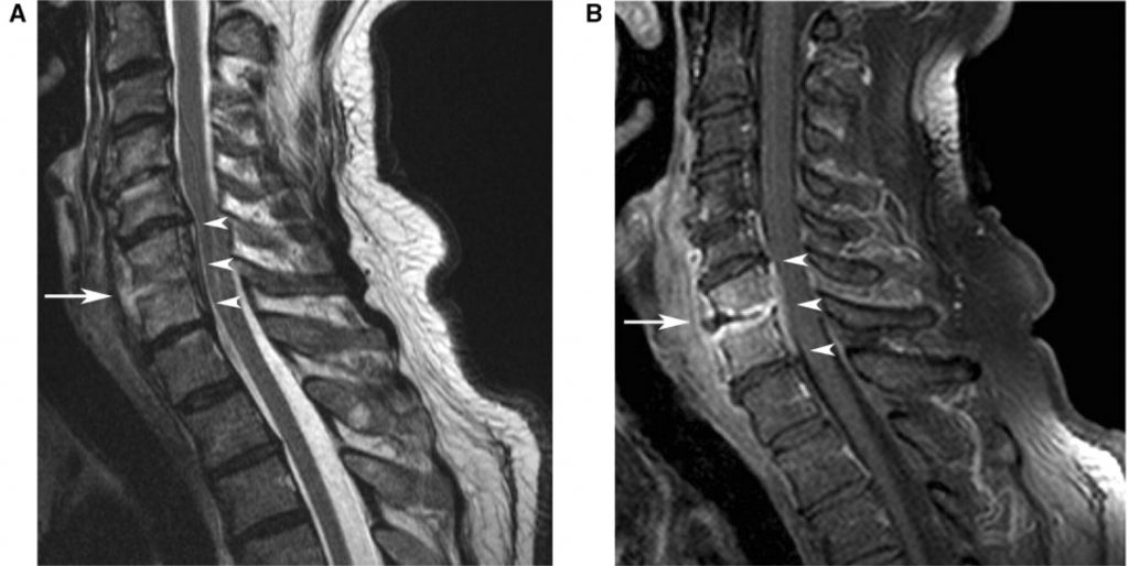 Epidural Abscess Stepwards