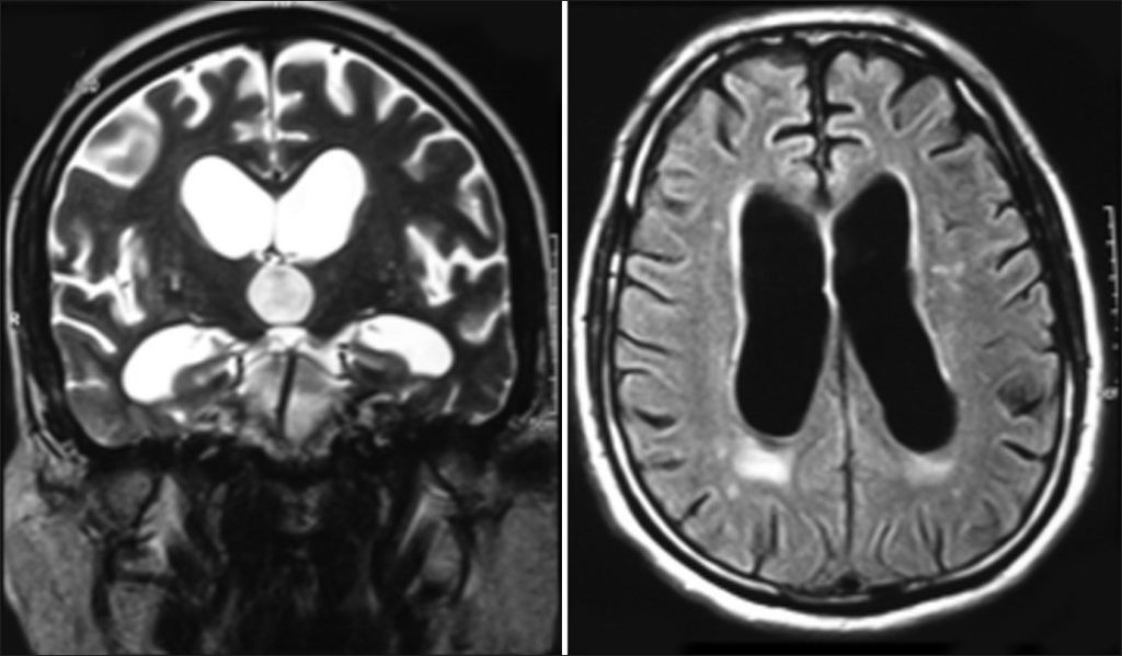 Normal-Pressure Hydrocephalus (NPH) - Stepwards