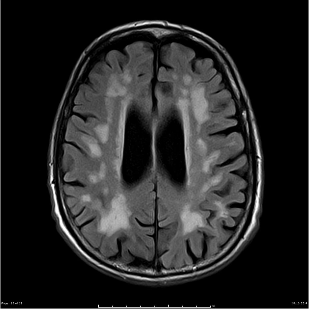 Vascular Dementia Stepwards