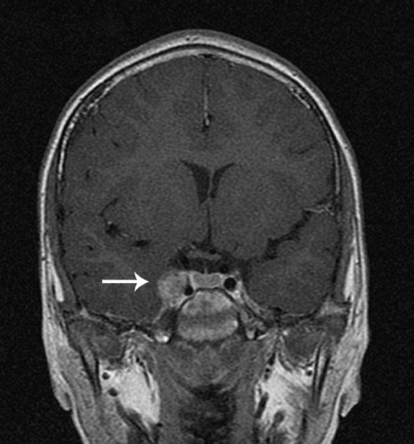 Cavernous Sinus Thrombosis (CST) - Stepwards