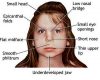 Fetal Alcohol Syndrome (FAS) - Stepwards