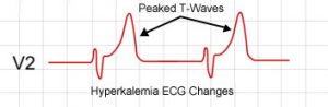 A Guide To Hyperkalemia - Stepwards