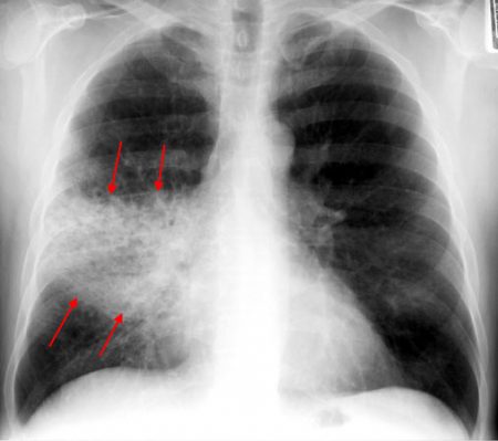 Picking The Right Antibiotic: Outpatient Community Acquired Pneumonia ...