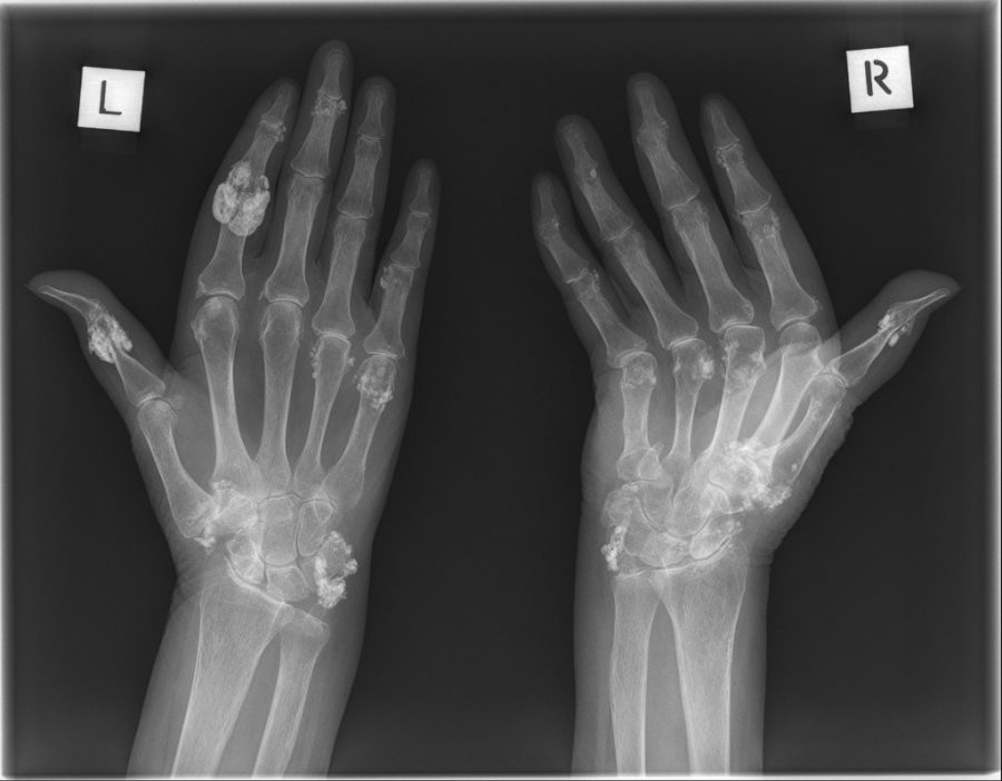 Condition Specific Radiology: Scleroderma (Systemic Sclerosis) - Stepwards