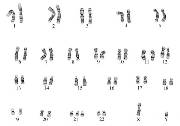 Archive Of Standardized Exam Questions: Down Syndrome (Trisomy 21 ...