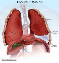 Pleural Effusion - Stepwards