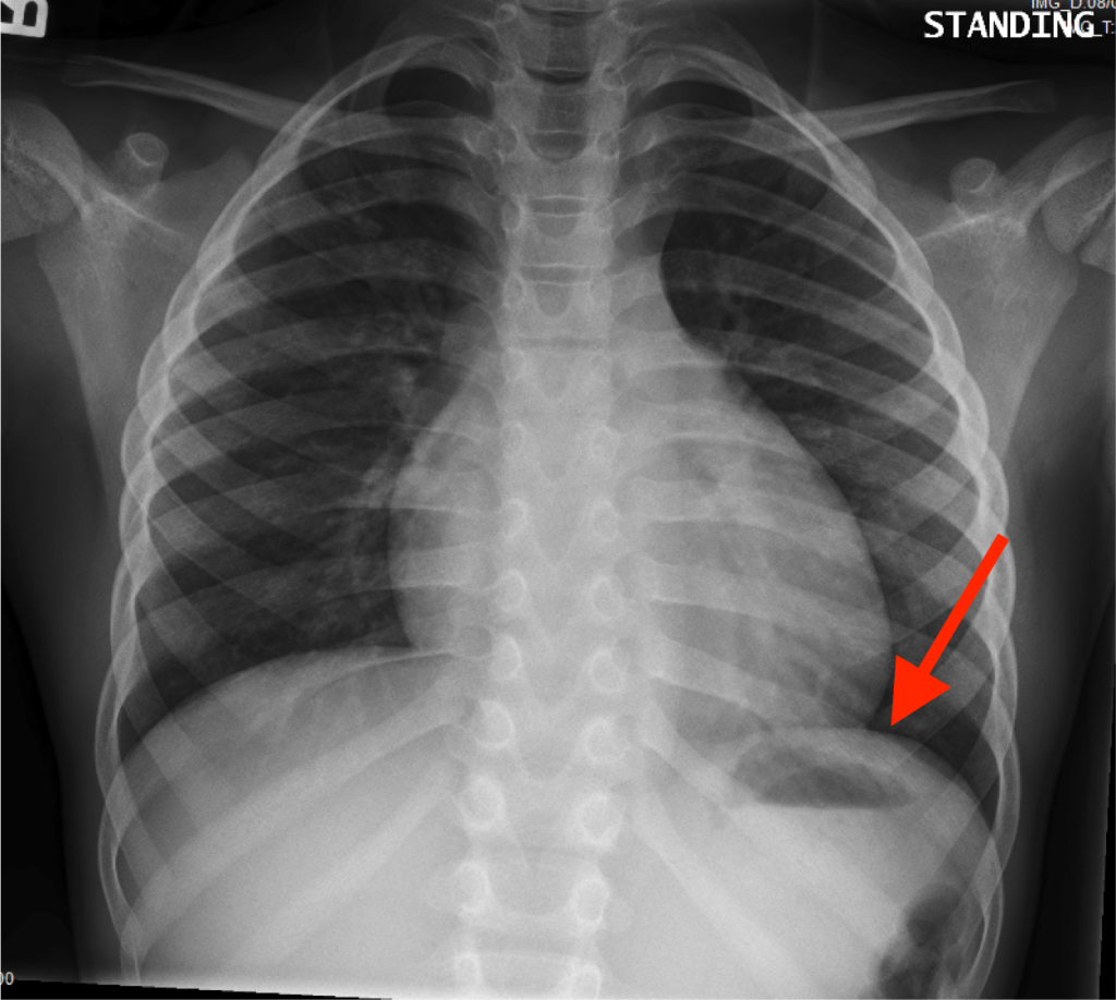 Radiological Anatomy Stomach Stepwards