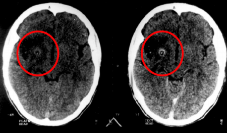 Fundamental Radiological Findings: Ring Enhancing Lesion - Stepwards