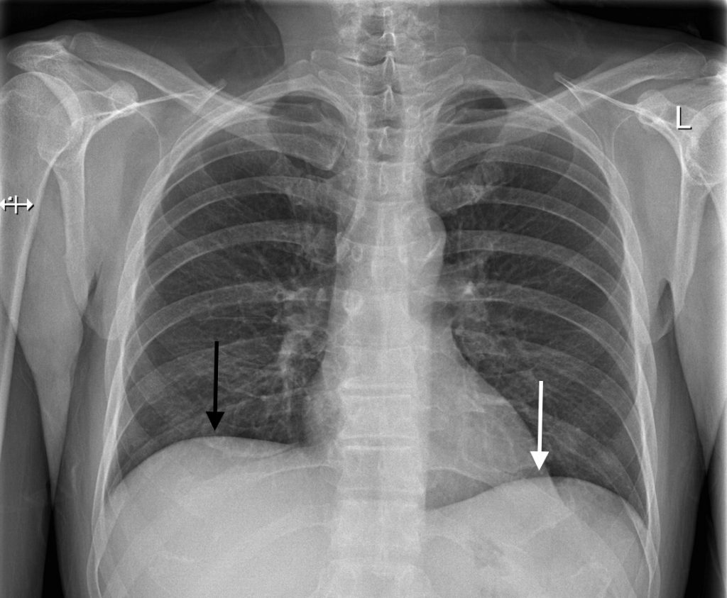 Radiological Anatomy: Diaphragm - Stepwards