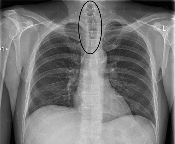 Radiological Anatomy: Trachea - Stepwards