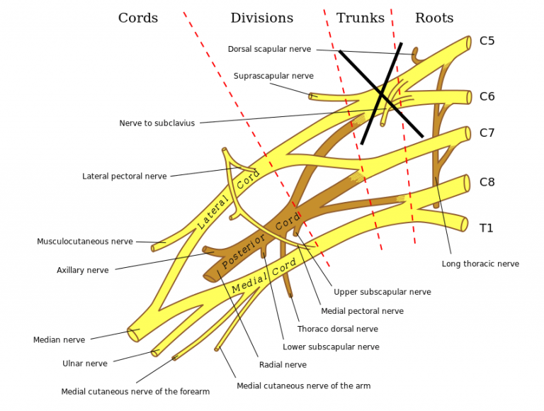 Erb Palsy (Erb-Duchenne Palsy) - Stepwards