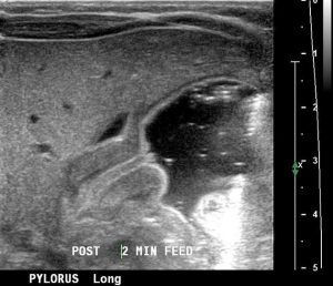 Pyloric Stenosis - Stepwards