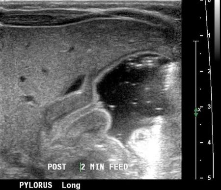 Pyloric Stenosis Stepwards   Ed2b615866607738d56490042b7bde Big Gallery 450x387 