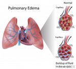 Condition Specific Radiology: Alveolar Pulmonary Edema - Stepwards