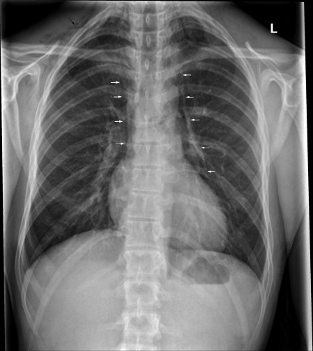 Fundamental Radiological Findings: Pneumomediastinum - Stepwards