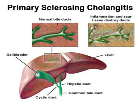 Primary Sclerosing Cholangitis - Stepwards