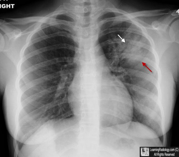 Fundamental Radiological Findings: Air Bronchograms - Stepwards