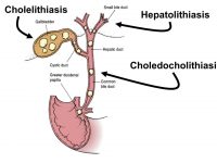 Choledocholithiasis - Stepwards