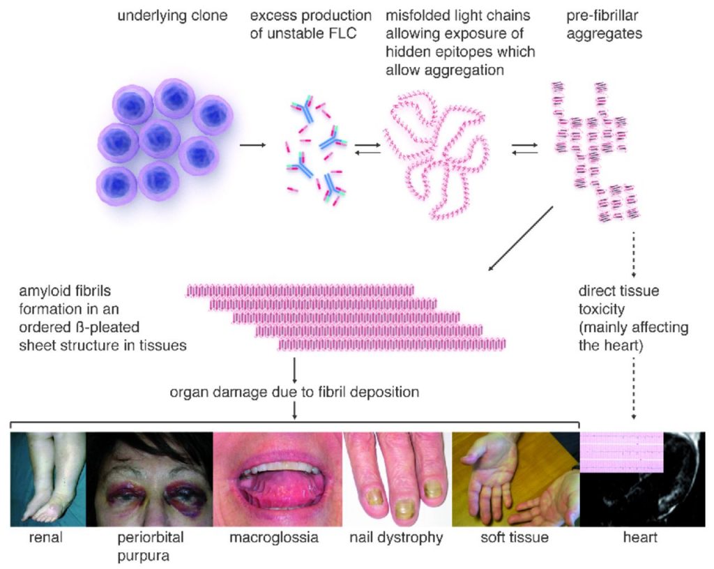 Amyloidosis - Stepwards