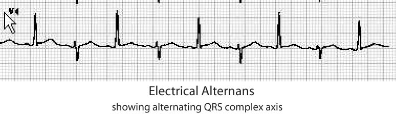 Electrical Alternans - Stepwards