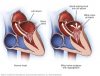 Guide To Heart Murmurs: Mitral Regurgitation Murmur - Stepwards