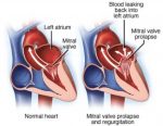 Guide To Heart Murmurs: Mitral Valve Prolapse Murmur - Stepwards