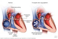 Guide To Heart Murmurs: Tricuspid Regurgitation Murmur - Stepwards