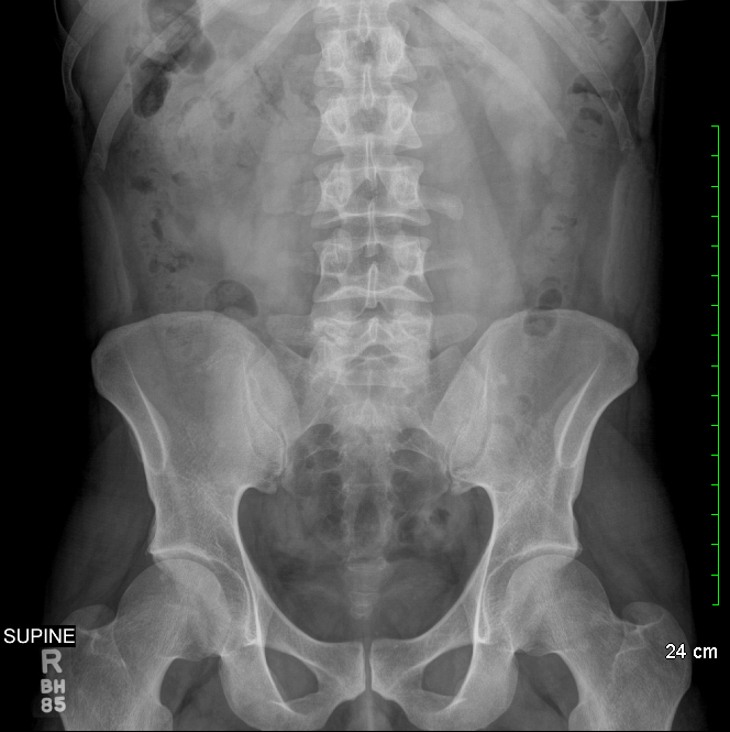 Archive Of Unremarkable Radiological Studies: Abdominal X-Ray (KUB ...