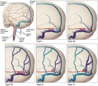 Condition Specific Radiology: Dural Arteriovenous Fistula - Stepwards