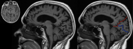 Radiological Anatomy: Calcarine Sulcus - Stepwards