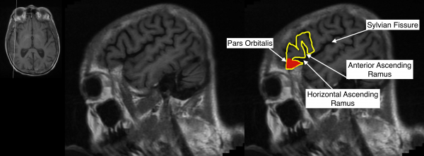 Radiological Anatomy: Pars Orbitalis - Stepwards