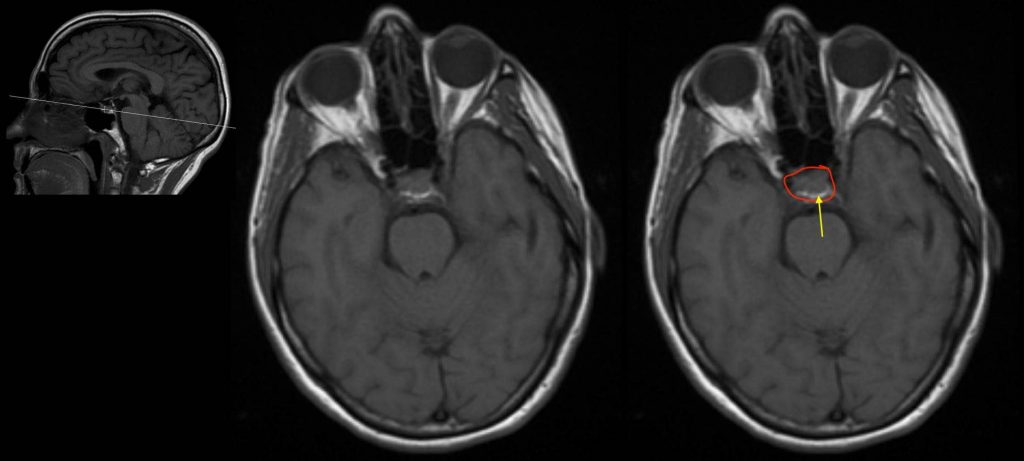 Radiological Anatomy Pituitary Gland Stepwards