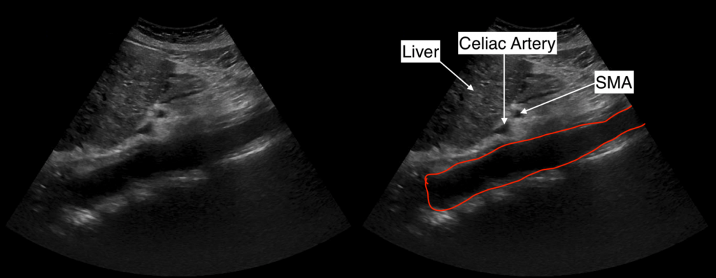 Protocoling Imaging Studies: Complete Abdominal Ultrasound (Ultrasound ...