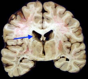 Archive Of Standardized Exam Questions: Huntington Disease (HD) - Stepwards