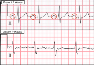 Electrocardiograms (ekgs Ecgs): Evaluating P Waves - Stepwards