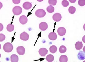 Archive Of Standardized Exam Questions: Hereditary Spherocytosis (HS ...