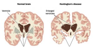 Archive Of Standardized Exam Questions: Huntington Disease (HD) - Stepwards