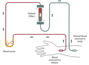 Interventional Radiology Procedures: Tunneled Hemodialysis Catheter ...