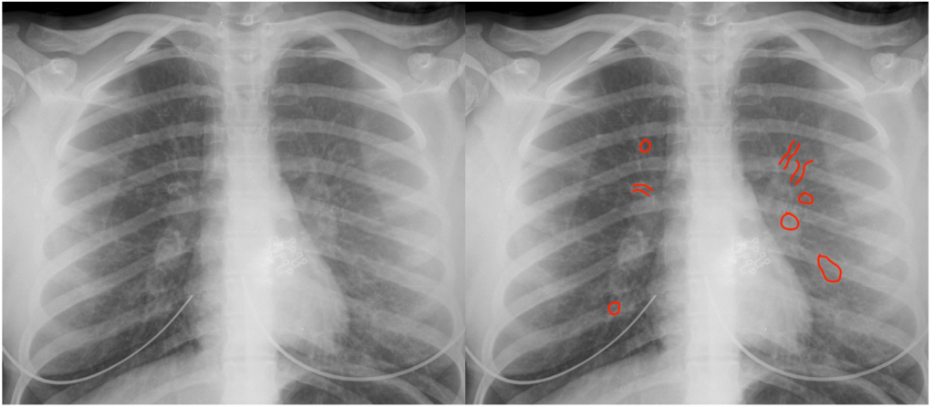 Fundamental Radiological Findings: Algorithmic Approach To Lung ...