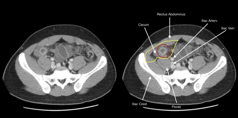 How To Find The Appendix On Imaging - Stepwards