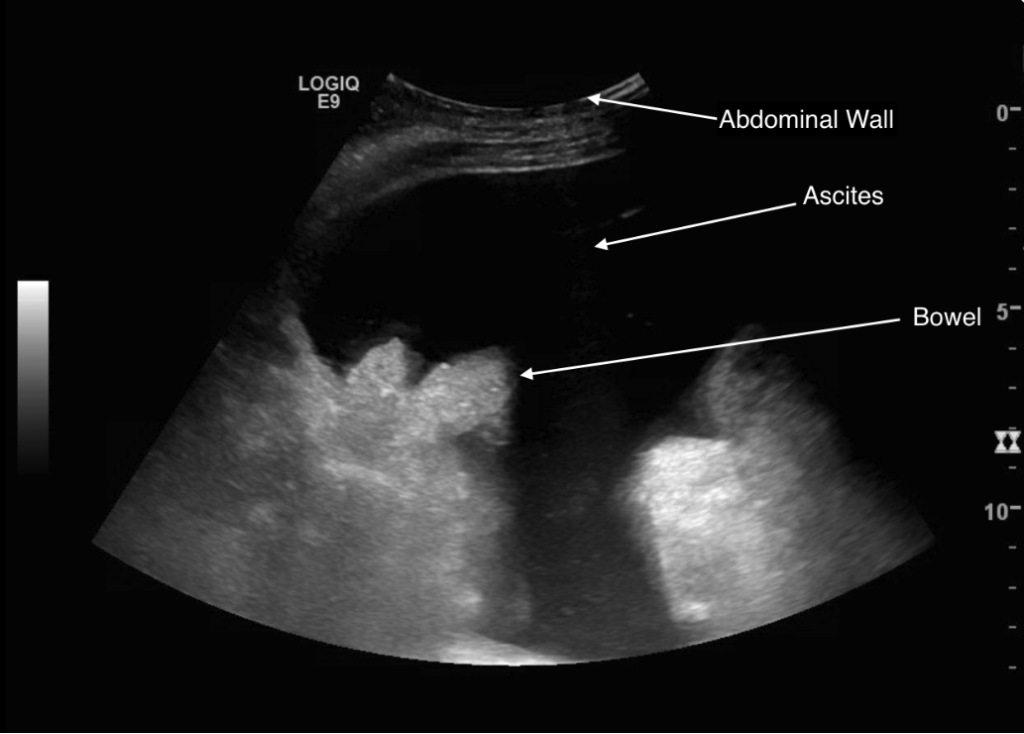 Radiology Procedures: Paracentesis (Scanning The Patient For Ascites ...