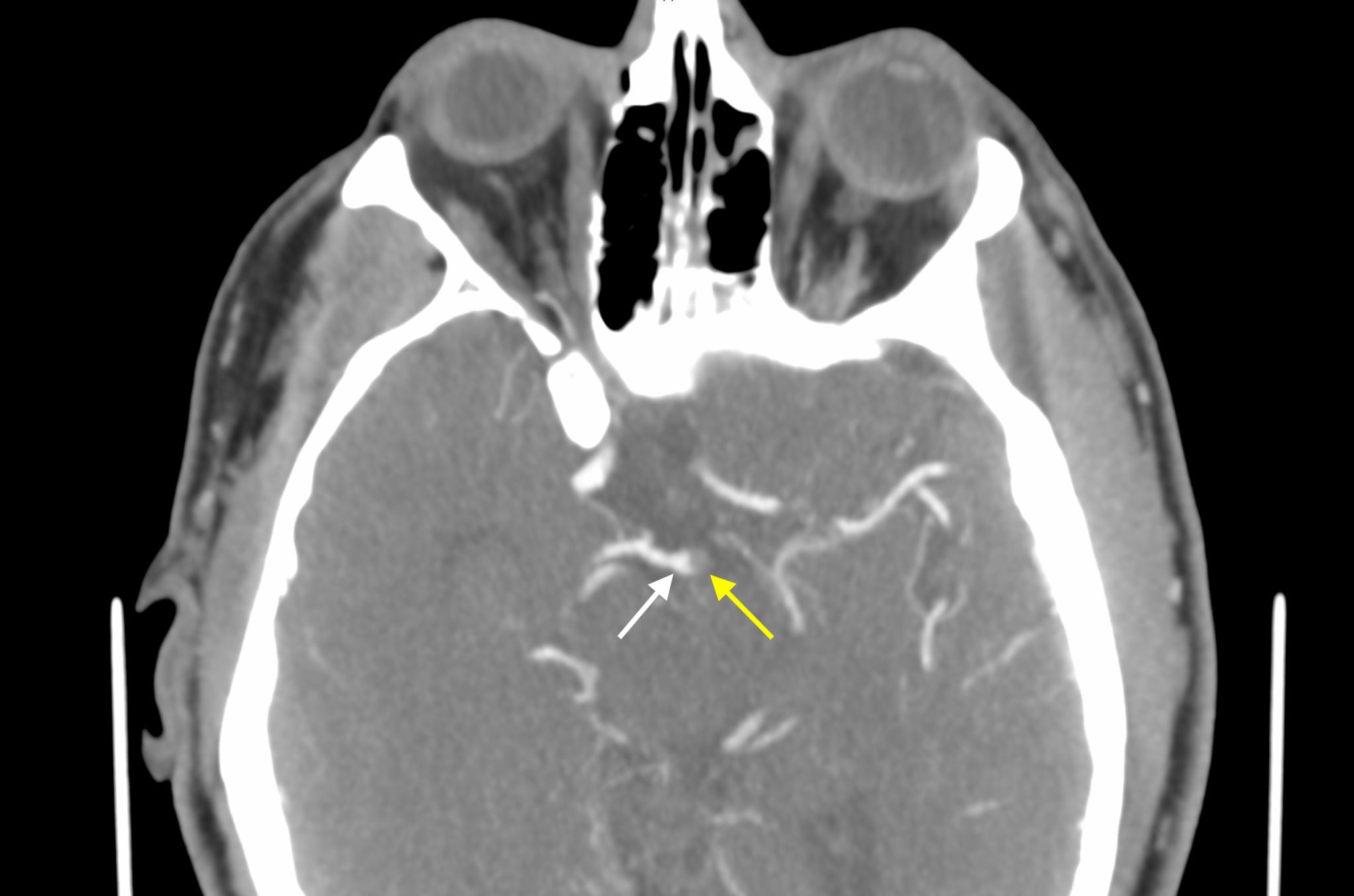 Neuroradiology Call Prep Cases: Basilar Thrombus (CTA) - Stepwards