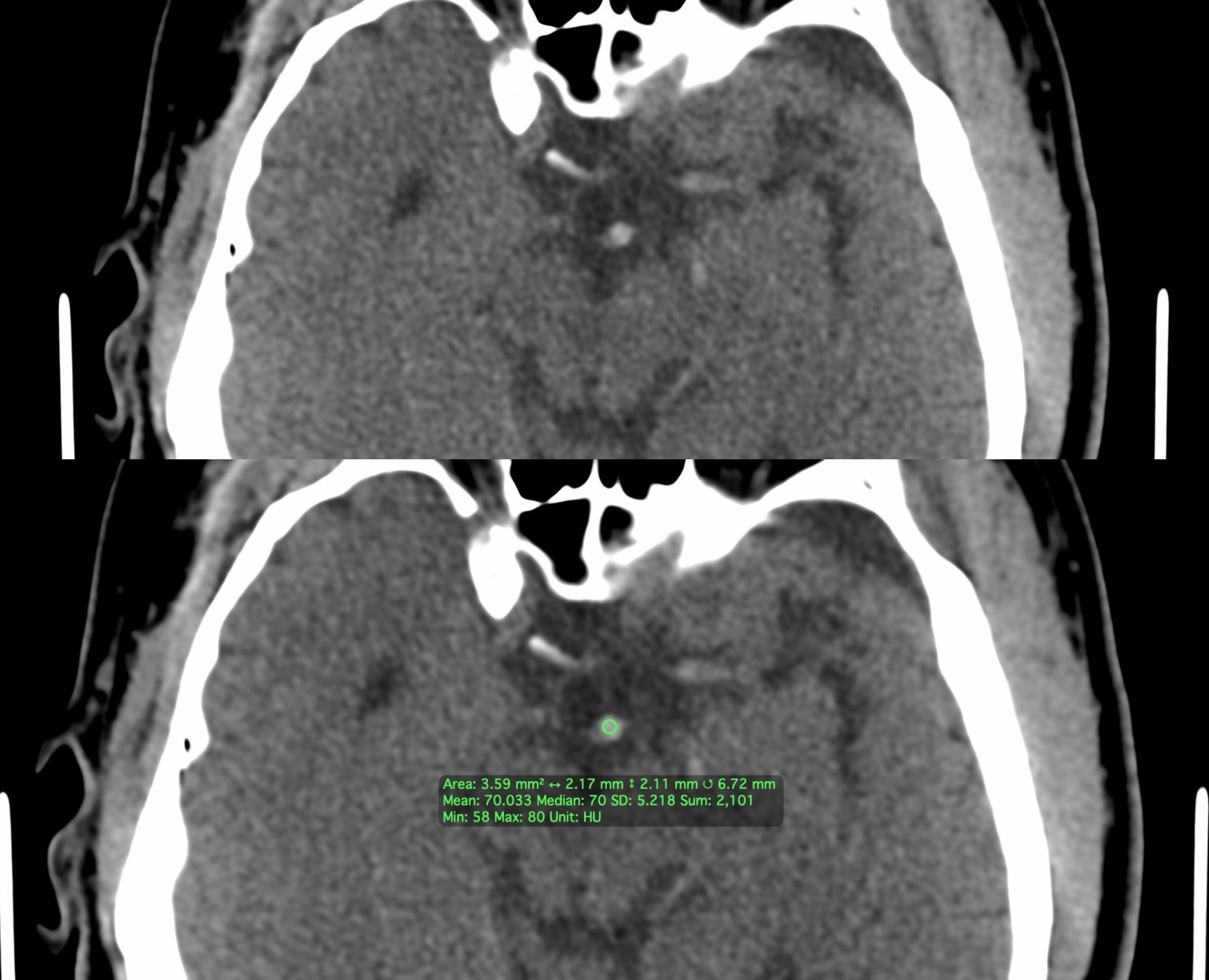 Neuroradiology Call Prep Cases: Basilar Thrombus (CTA) - Stepwards