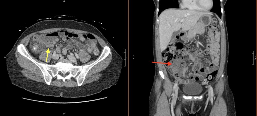 Abdominal Imaging Call Prep Cases: Acute Uncomplicated Appendicitis (ct 