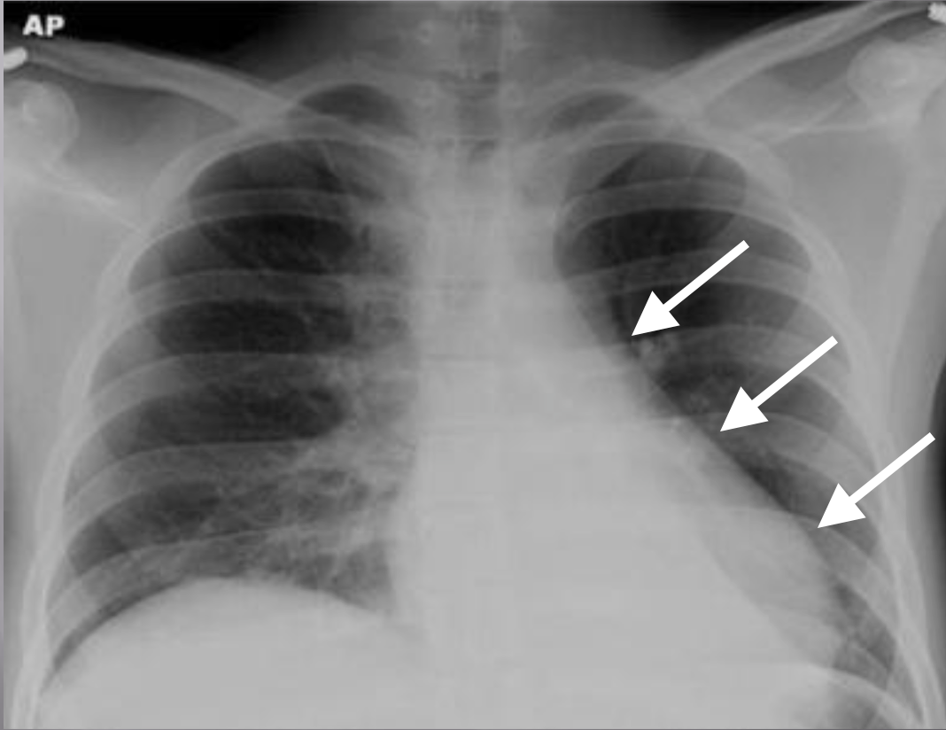 Condition Specific Radiology: Atelectasis – Stepwards